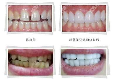 牙元素口腔门诊牙修复前后