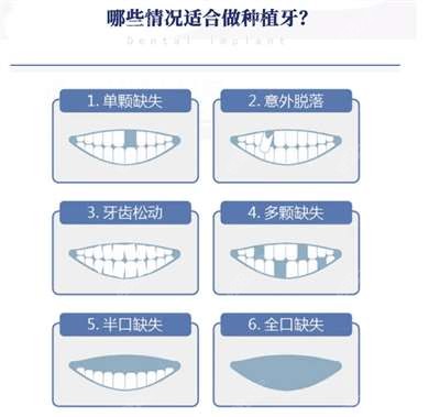 哪些情况适合做种植牙