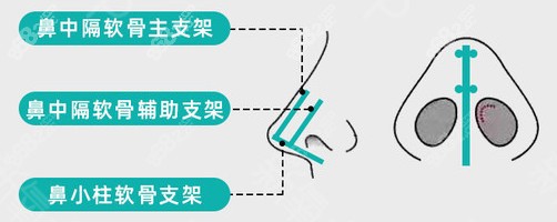 肖凌做半肋骨鼻综合手术原理