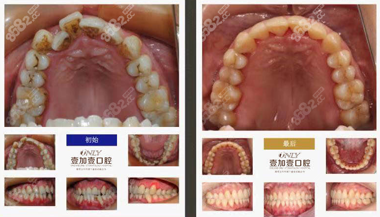 北京壹加壹口腔牙齿矫正案例效果图