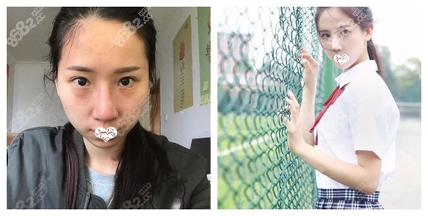 恒博天姿整形肖凌做半肋骨鼻综合效果对比图