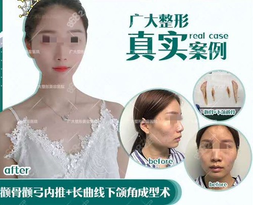 廣州廣大下頜角磨骨真人案例