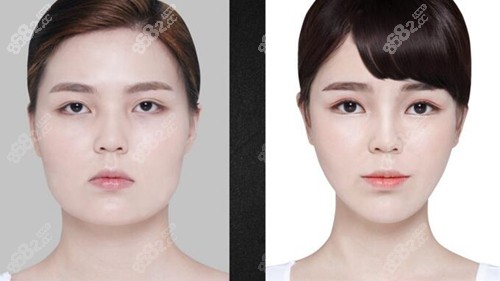 韓國必當(dāng)歸醫(yī)院下頜角磨骨真人案例