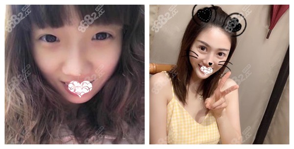 肖凌做半肋骨鼻综合案例