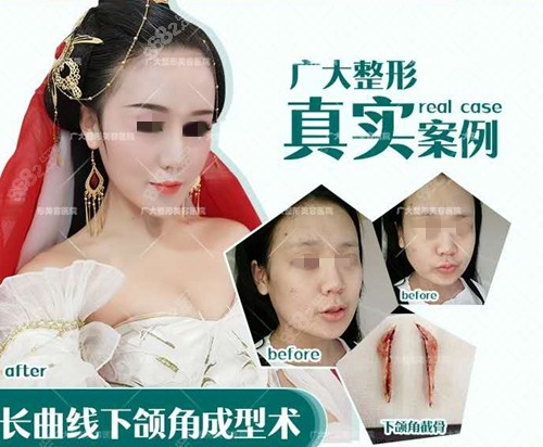 廣州廣大下頜角磨骨案例