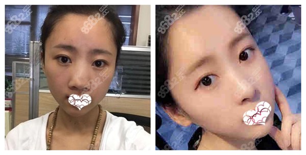 成都肖凌医生做半肋骨鼻综合效果图