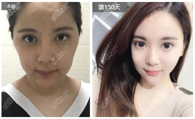 天津閆騰元面部脂肪填充案例效果參考
