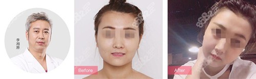 李湘原削骨案例 李湘原削骨案例