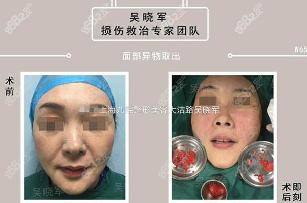苹果肌注射刺激自身胶原再生的不明物质取出前后对比