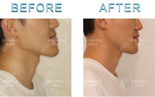 張棟梁疑難骨性正畸矯正案例