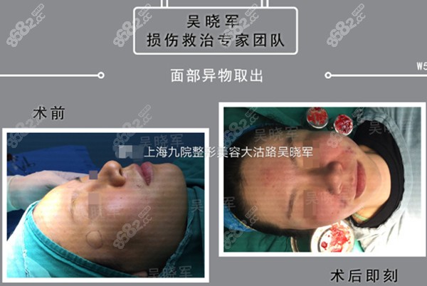 玻尿酸填充太阳穴不消融成硬结做取出修复