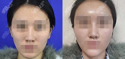 合肥恒美面部填充前后对比