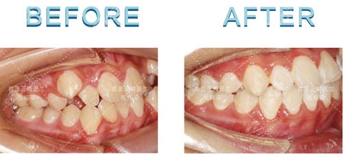 張棟梁舌側(cè)矯正案例