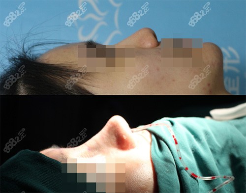 合肥恒美廖亚敏院长隆鼻