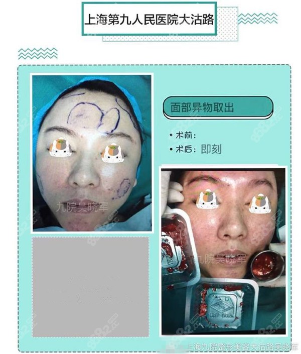多次注射了不同填充物，进行面部异物取出
