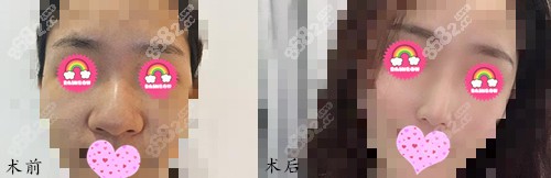 鼻部手術(shù)案例效果 鼻部手術(shù)案例效果
