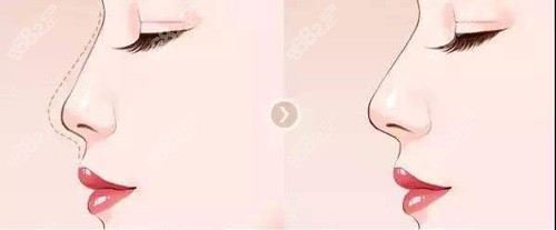 術(shù)前術(shù)后對比圖 術(shù)前術(shù)后對比圖