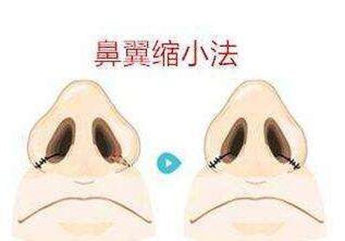鼻翼縮小術(shù) 鼻翼縮小術(shù)