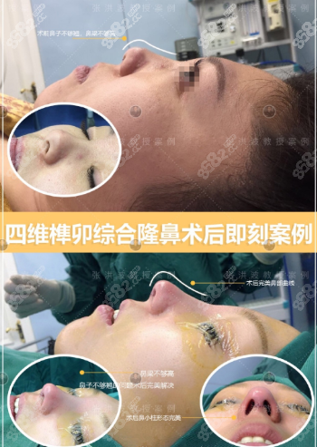 南京<!--<i data=20240705-sp></i>-->張洪波四維榫卯鼻綜合案例圖