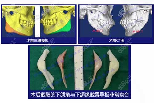 3D导板设计前后对比图