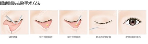韩国必当归去眼袋手术方法展示