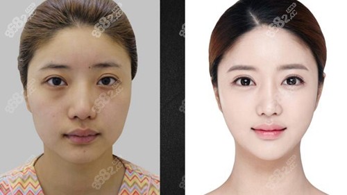 韩国必当归去眼袋技术好吗？附真人去眼袋案例