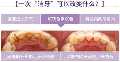 洗牙效果图片