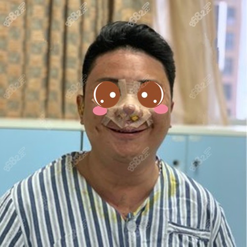 做完肋骨鼻后并沒有那么疼 做完肋骨鼻后并沒有那么疼