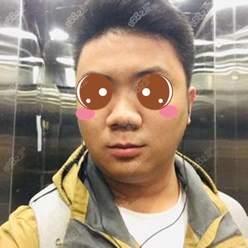 找劉容嘉醫(yī)生做鼻子前 找劉容嘉醫(yī)生做鼻子前