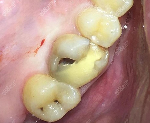 补牙材料掉了牙洞发黑