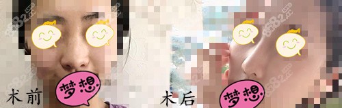 广州韩妃整形鼻部手术案例