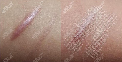 激光祛疤前和治疗后