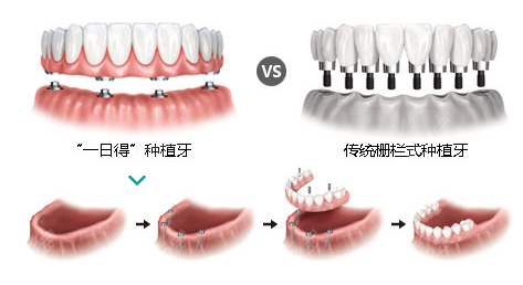 <!--<i data=20240705-sp></i>-->口腔种植牙技术优势