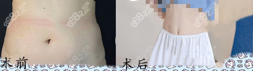 广州韩妃整形腰腹环吸案例