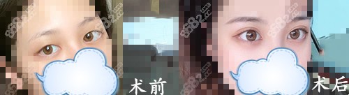 广州韩妃整形双眼皮手术案例