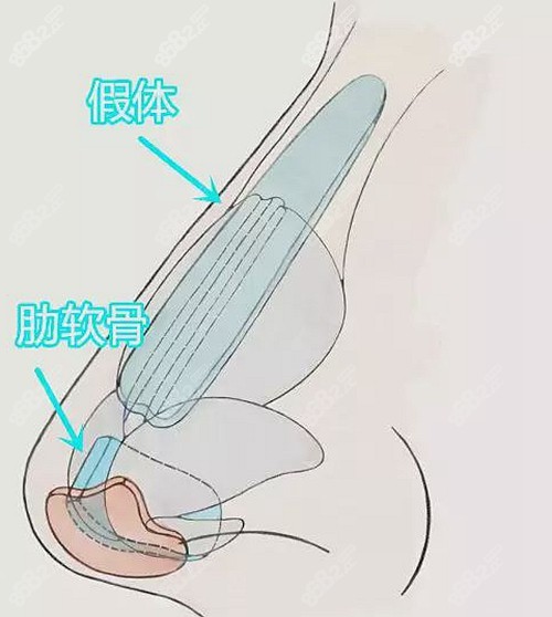 肋骨鼻放置图解图片