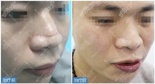 深圳鹏程疤痕治疗案例