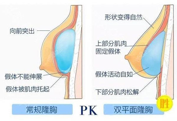 赵翊利医生隆胸采用的手术原理