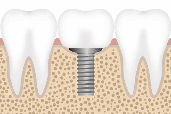 种植牙示意图