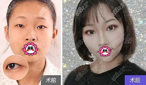 北京美莱急速纳米美眼2.0真人案例一