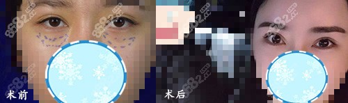广州韩妃整形医院眼部修复对比案例