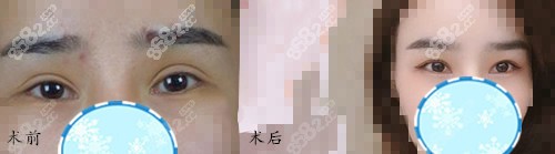 广州韩妃整形医院眼部修复案例