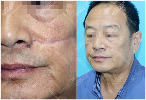 深圳鹏程疤痕治疗案例