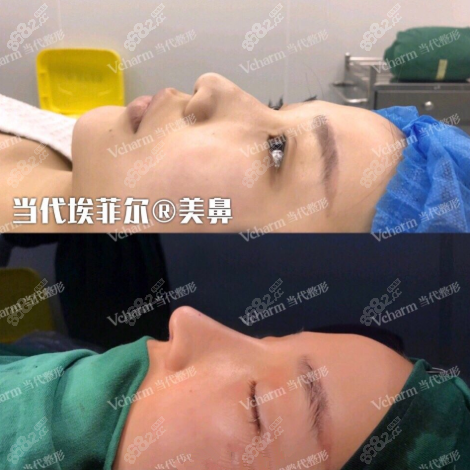 王旭明埃菲尔鼻综合案例图