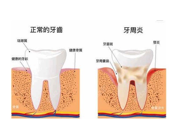 激光牙周炎刮治