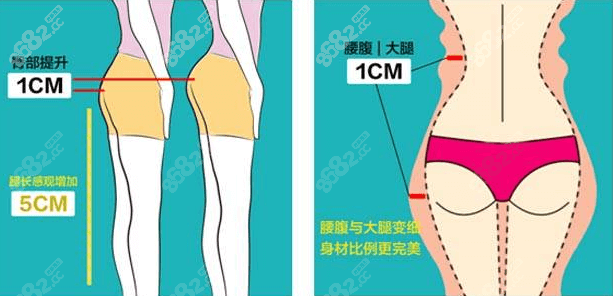 北京禾美嘉腿型矫正遵循设计示意图