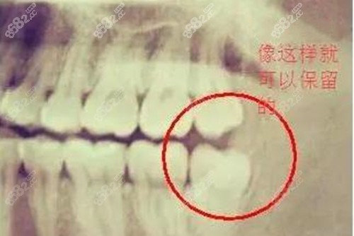 可以不用拔的智齿