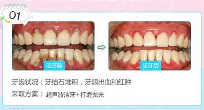 洗牙效果图展示