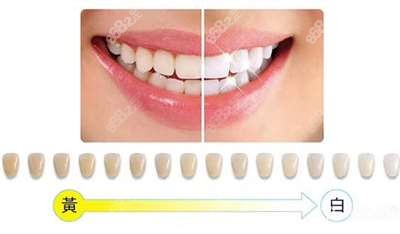 牙齿美白程度示意图