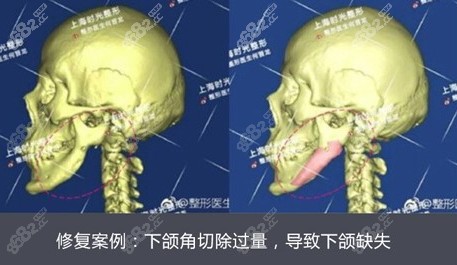 上海时光何晋龙实例解析,get下颌骨颌面整形失败修复新方式